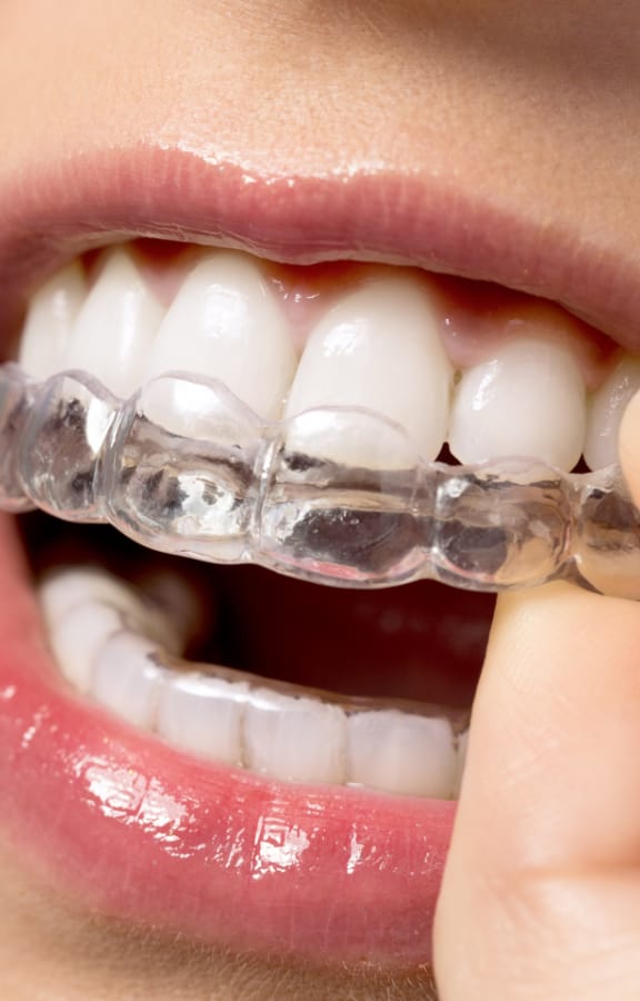 Clear aligner being put on the upper teeth